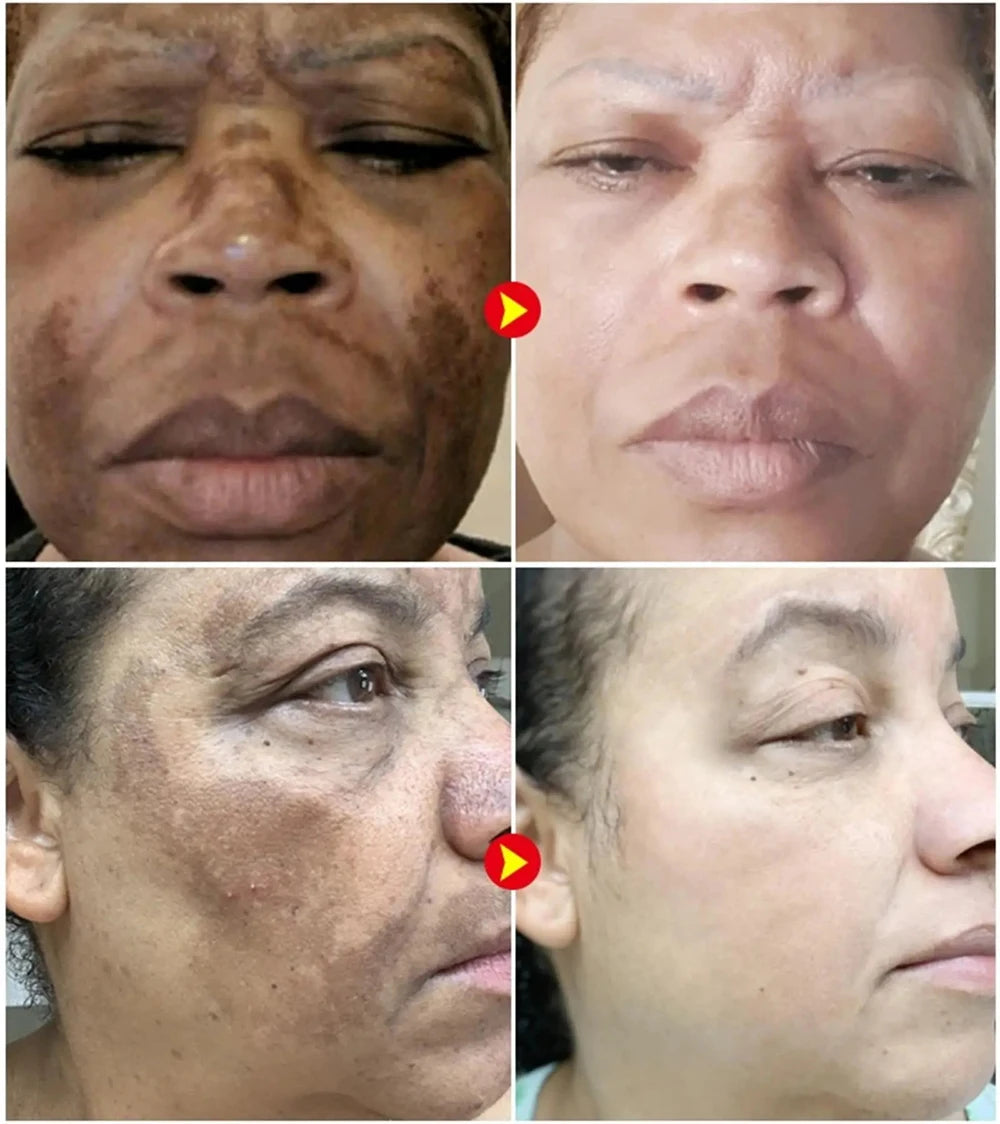 Play Video Powerful Spot-removing Whiten Cream Brighten Skin Fast Eliminates Melanin Pigmentation Melasma Dark Spots Korean Sk