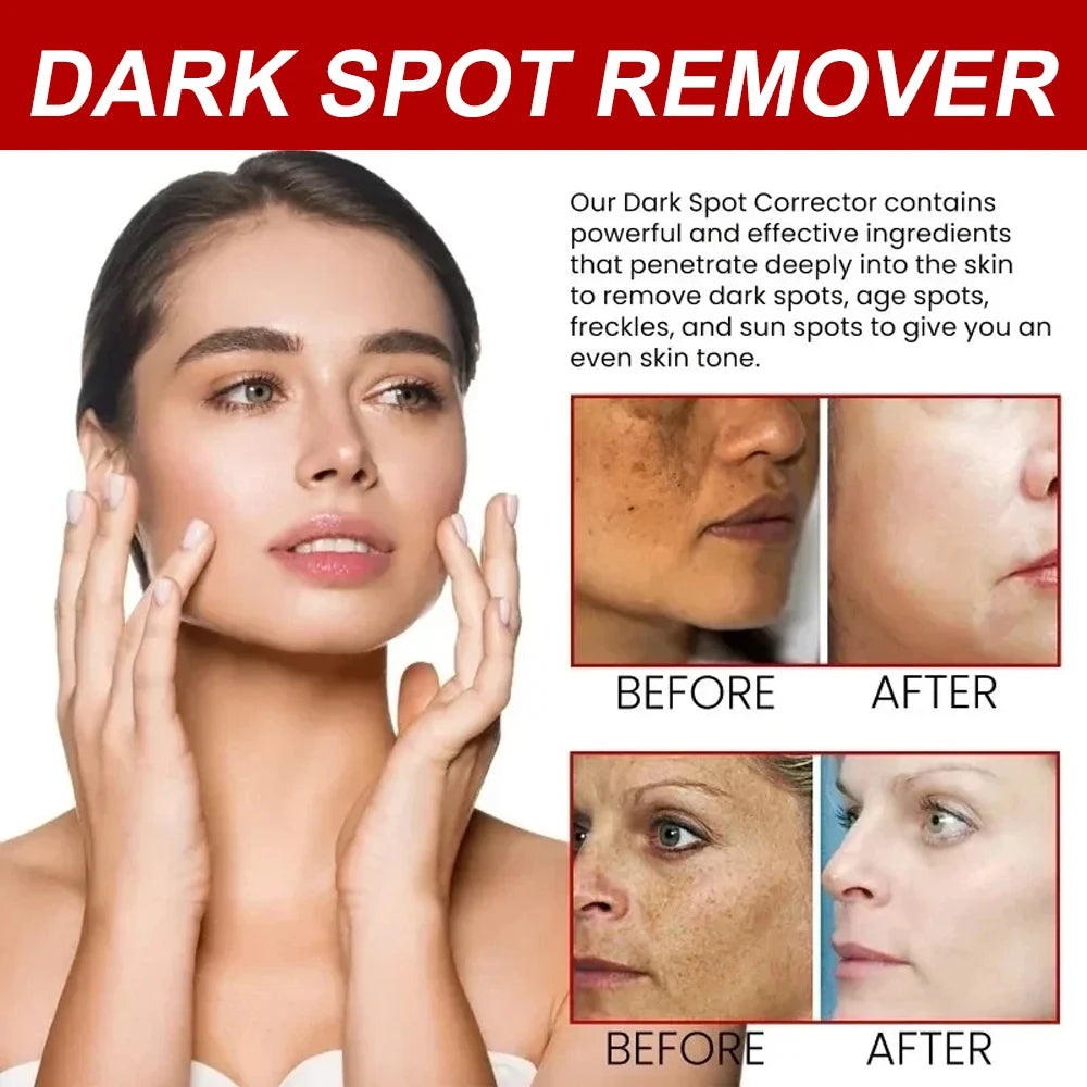 Play Video Powerful Spot-removing Whiten Cream Brighten Skin Fast Eliminates Melanin Pigmentation Melasma Dark Spots Korean Sk