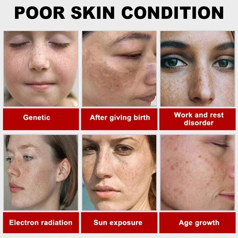 Play Video Powerful Spot-removing Whiten Cream Brighten Skin Fast Eliminates Melanin Pigmentation Melasma Dark Spots Korean Sk