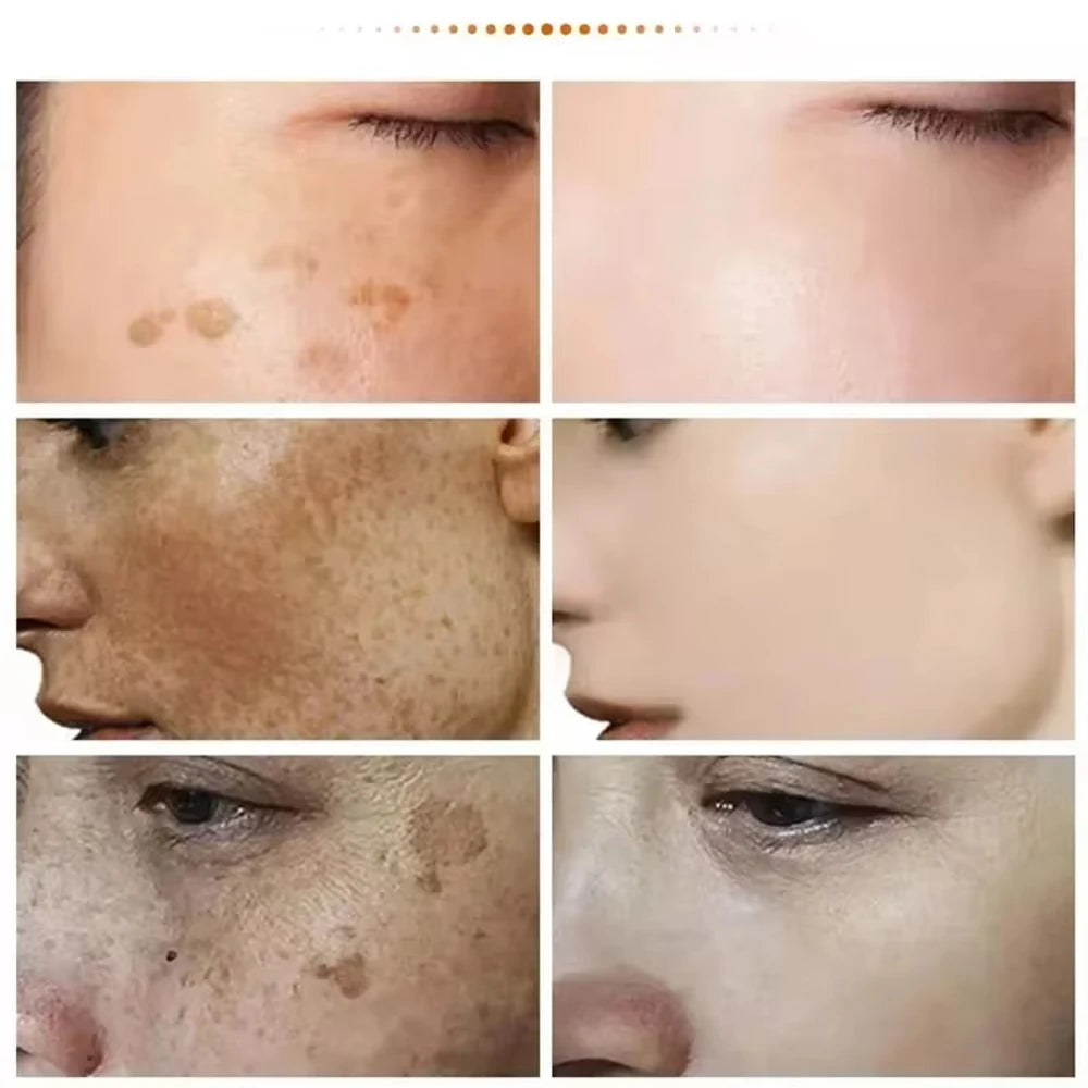 Play Video Powerful Spot-removing Whiten Cream Brighten Skin Fast Eliminates Melanin Pigmentation Melasma Dark Spots Korean Sk