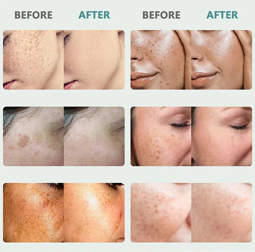 Play Video Powerful Spot-removing Whiten Cream Brighten Skin Fast Eliminates Melanin Pigmentation Melasma Dark Spots Korean Sk