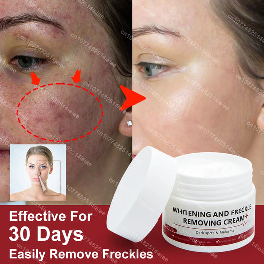 Play Video  Powerful Spot-removing Whiten Cream Brighten Skin Fast Eliminates Melanin Pigmentation Melasma Dark Spots Korean Sk